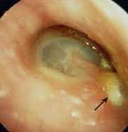 Ear Infection Ear Infection